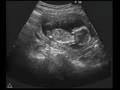 Ultrasound Fetal Response To Alcohol Fetal Alcohol Syndrome