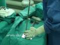 Scoliosis surgery - www.skolioza.org - operacja z dostępu przedniego