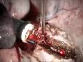 NOTES – Surgery Using Natural Orifice (Transgastric) NOTES – Surgery Using Natural Orifice (Transgastric)