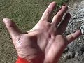 dupuytren contracture 1-22-07
