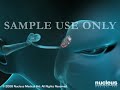 3D MEDICAL ANIMATION- TONSILLECTOMY & ADENOIDECTOMY SURGERY