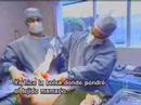 liposuccion lipectomía y levantamiento de senos