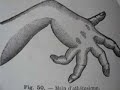 History of neurology, Grasset 1889 IOCOB History of neurology, Grasset 1889 IOCOB