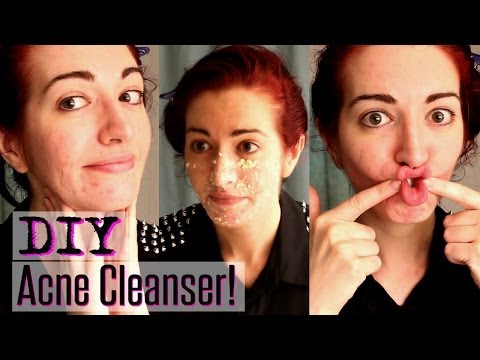 how to cure oily skin pimples