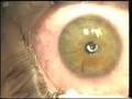 The Fladen Eye and Lasik Center: PRK
