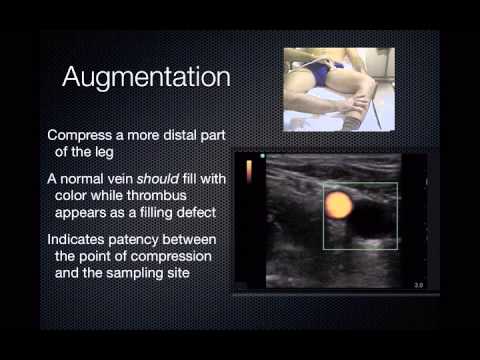 how to perform dvt ultrasound