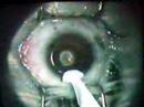 Lasik Eye Surgery