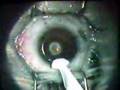 Lasik Eye Surgery