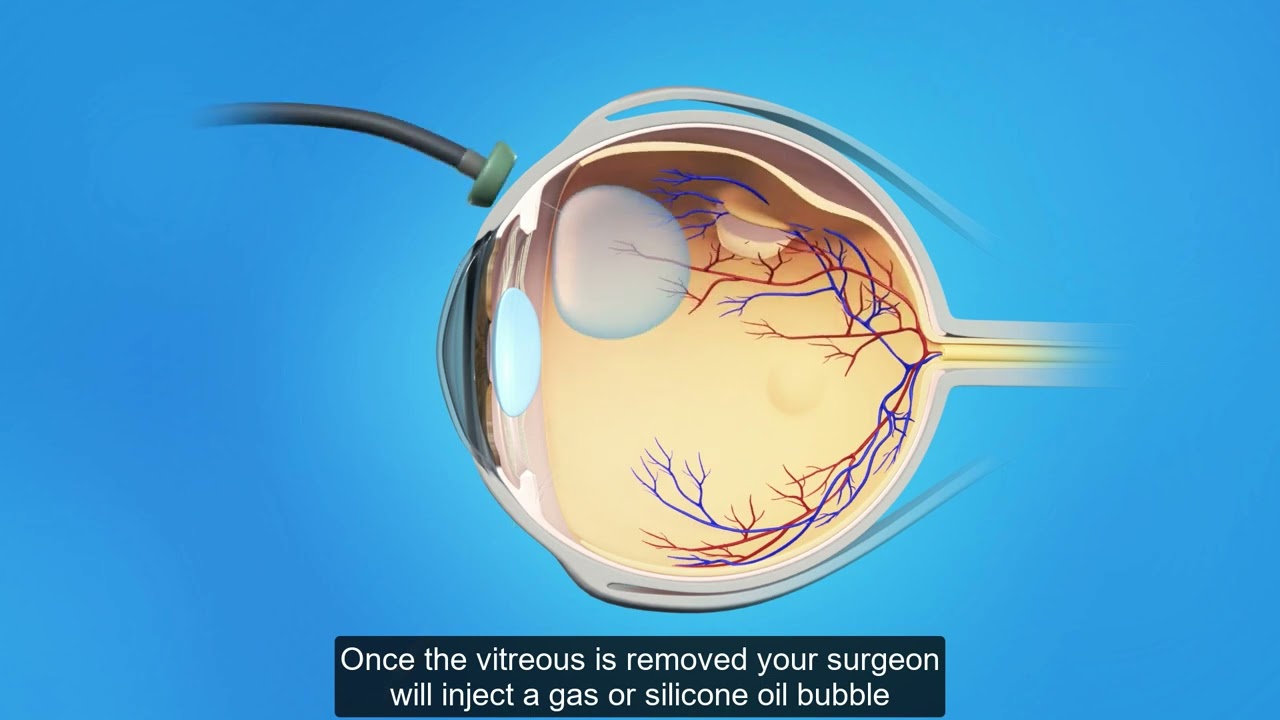 Retina Detached Vitrectomy