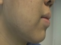 http://www.AcnePractice.com      a revolutionary new acne program....