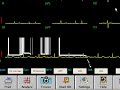 ECG recording with eClinicalWorks