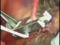 Anastomosis (CABG) procedure featuring Cardica\