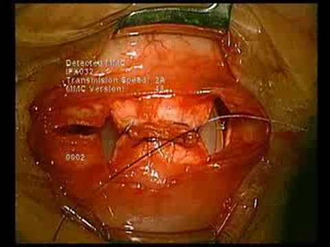 evisceration - painful amaurosis after several failed retinal surgeries.