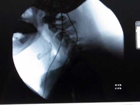 how to treat epiglottis