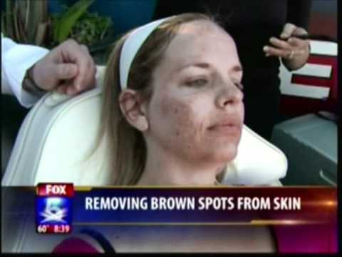 how to remove dark spots on face