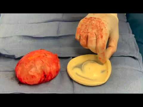 Breast implant removal reviews image