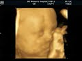 3d-4d-ultrasonografia-rosto-crianca-face