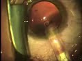 ICL Surgery