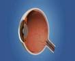 Desprendimiento de retina