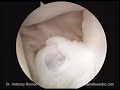 From Open to Arthroscopic Rotator Cuff Repair with Anthony A. Romeo, M.D., Part 2 From Open to Arthroscopic Rotator Cuff Repair with Anthony A. Romeo, M.D., Part 2