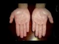 me Sudan las Manos [Hiperhidrosis]
