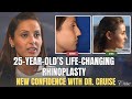 Nose Surgery, Chin Implant by Dr. Cruise