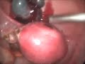 Vídeo laparoscopia de uma Gravidez ectópica integra de 10 cm da trompa esquerda. Remoção total da trompa. Parte 2 de 2