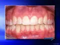 Damon? System - Wilson Orthodontics - Gainesville  GA