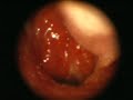 Adenoid Hypertrophy