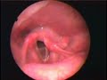 Parálisis de cuerda vocal izquierda