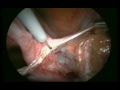 Isolation and ligation of uterine arteries at its origin