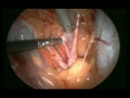 Uterine arteries are isolated and ligated before total laparoscopic hysterectomy