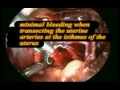 Isolation and ligation of uterine arteries at its origin