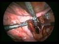 Isolation and ligation of uterine arteries at its origin