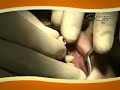 Implante Friccional KOPP - Ceraone
