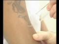 Laser Tattoo Removal on Dark Skin with the MedLite