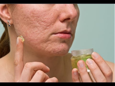how to avoid pimples