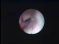 videos de Endoscopic Third Ventriculostomy
