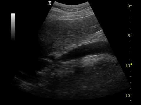 how to treat low cvp