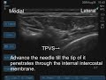 USG-Thoracic paravertebral block for pediatric patients USG-Thoracic paravertebral block for pediatric patients
