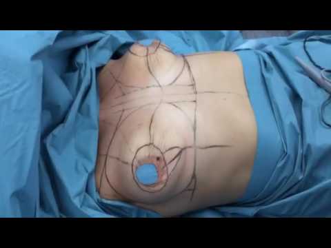 Увеличение груди на круглых имплантах