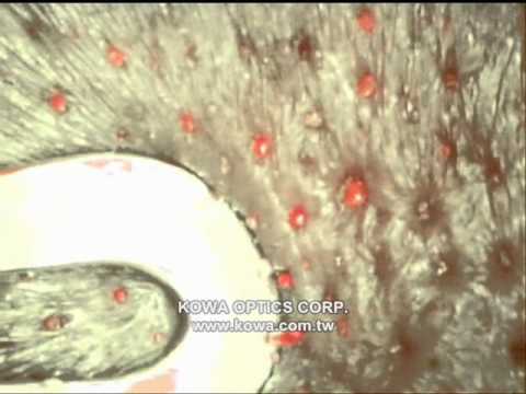 Acne Inspection Scope - KOWA OPTICS CORP.