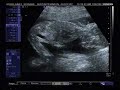 2nd Ultrasound 24-Jul-2007