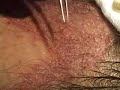 Dallas hair transplant:  graft placement video 2