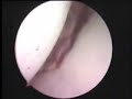 Bankart Hillsachs lesion shoulder dislocation Arthroscopy ??????????? ???????????????