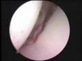 Bankart Hillsachs lesion shoulder dislocation Arthroscopy หัวไหล่หลุด ผ่าตัดส่องกล้อง