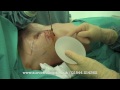 Breast Augmentation Surgery Placing the Implants Behind the Muscle