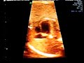 Ma premiere fille - Deuxi�me �chographie