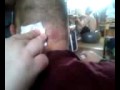 Zit on the back of p.j.s head