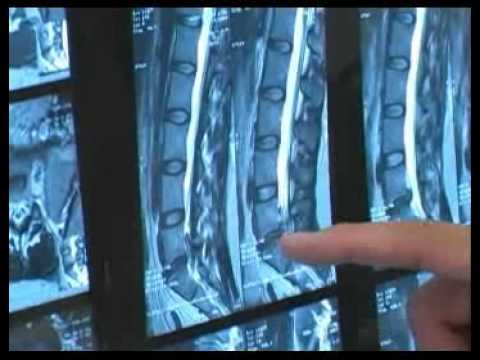 how to locate lumbar 1